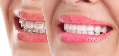 The image shows a close-up of a person s smiling face with their teeth, displaying a dental product advertisement.