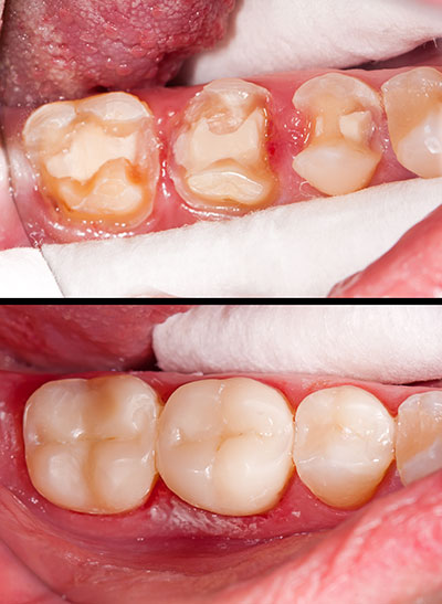 Image of a person s mouth with multiple teeth in various stages of decay and damage, showcasing dental neglect.