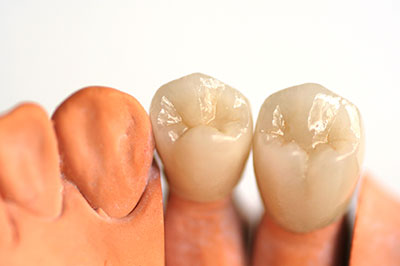 A close-up of two dental implants with a natural tooth in between, showcasing the process of dental restoration.