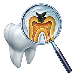 An illustration of a dental x-ray with an enlarged view of a tooth s root and surrounding bone, viewed through a magnifying glass.