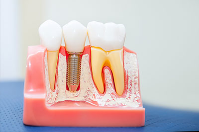 An image of a dental model with multiple teeth showing varying stages of decay, including yellow staining and cavities, with a single visible metal screw or pin inserted into the lower front tooth area.