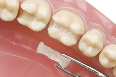 The image shows a close-up of a dental prosthetic with a visible filling being replaced, featuring a toothbrush and dental tools.