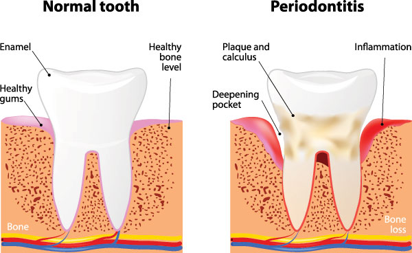 The image is a three-panel illustration depicting the stages of tooth decay, from normal to severe, with accompanying labels for each stage.