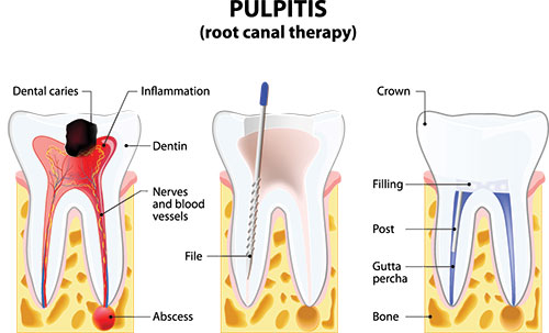 The image is a medical illustration showing a cross-section of a tooth with pulpitis, highlighting the inflammation and infection in the pulp chamber.