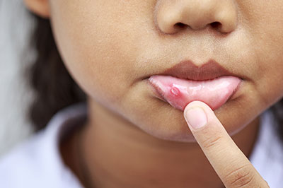 The image shows a close-up of a child s face with a focus on their lips, which appear to be affected by a skin condition or irritation.