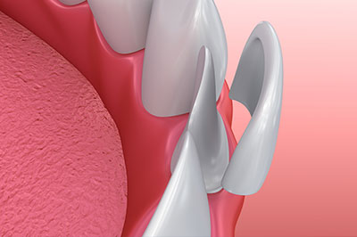 The image shows a close-up of a dental implant with a pink gum background, highlighting the metallic and porous structure of the implant.