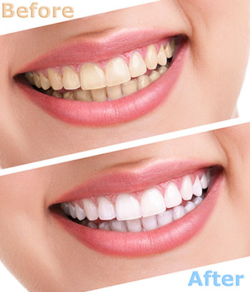 The image shows a woman s smile before and after teeth whitening treatment, emphasizing the transformation achieved through dental care.