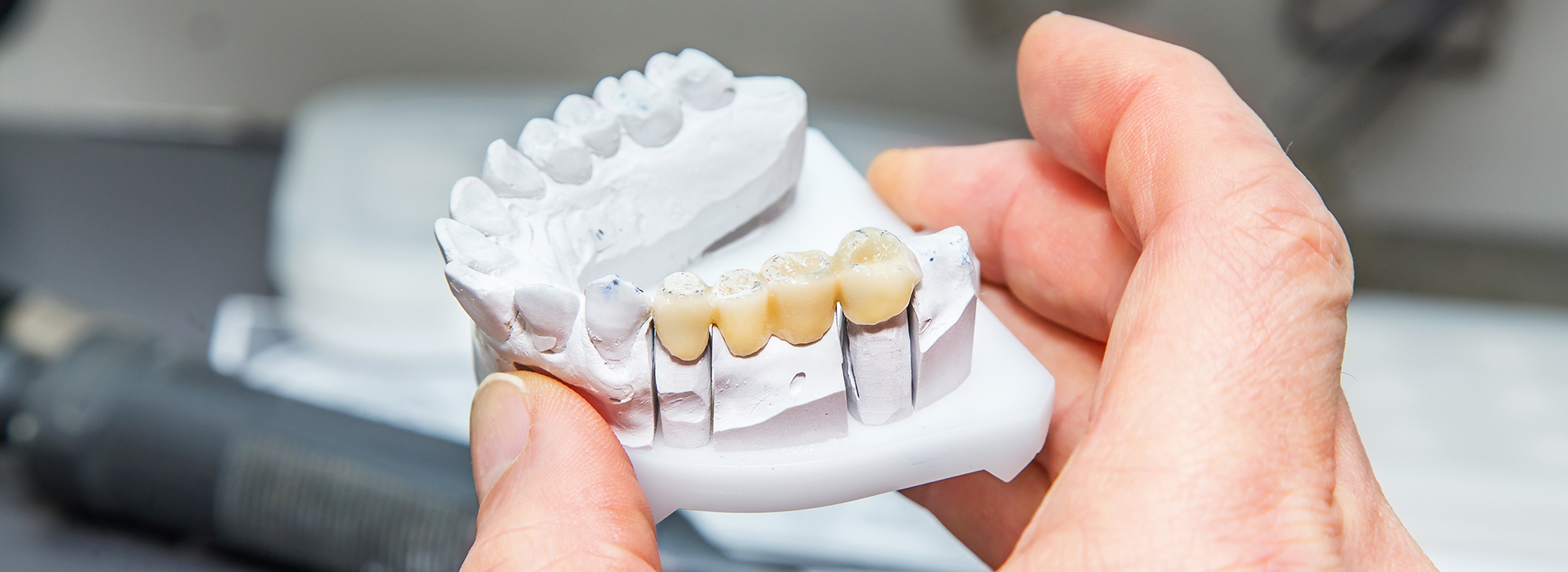 A person holding a dental implant with multiple teeth, showcasing the product.