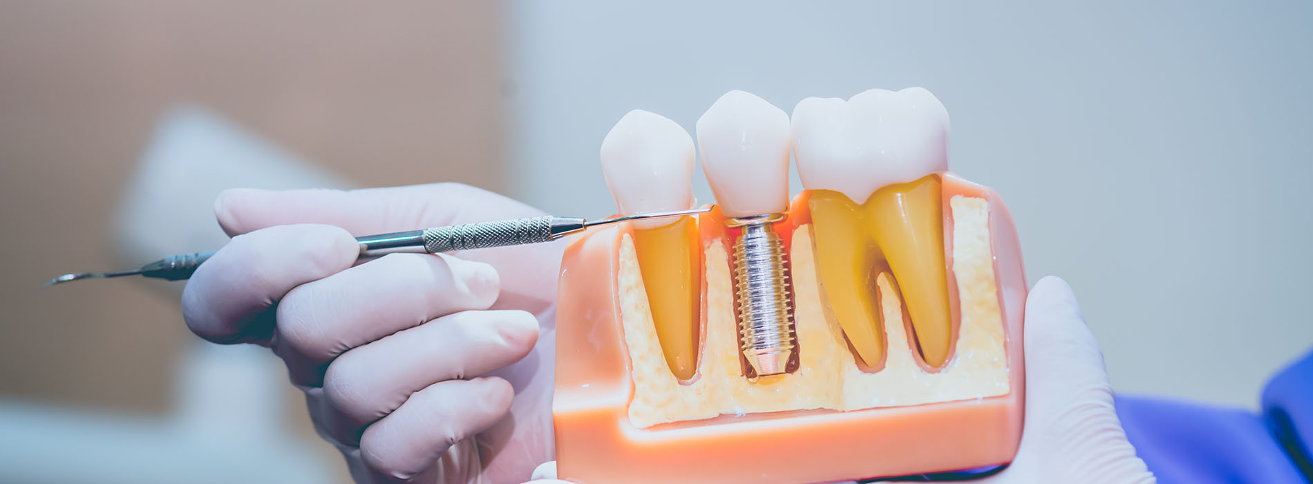 Close-up of a person holding an orange dental mold with teeth implants.