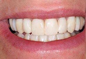 The image shows a close-up of a person s smile, focusing on their teeth and gums.