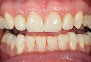The image shows a close-up of a person s teeth with some discoloration, particularly noticeable on the front teeth, which are yellowed and have stains.
