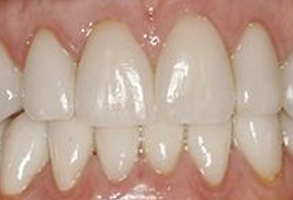 An image of a person s teeth with a focus on the yellowing, possibly indicating dental health concerns.