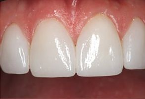White teeth in a smiling mouth, showcasing dental implants.