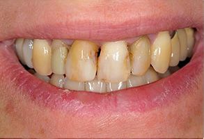 The image shows a close-up of a person s teeth with yellow staining, suggesting the need for dental care or whitening.