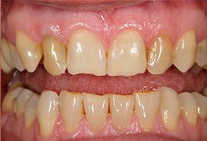 An image of a person s teeth, showcasing a dental treatment with visible yellow stains and a pink gumline.