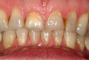 Image of a person s teeth showing signs of decay and discoloration, with a focus on the lower front teeth.